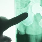 Hip Replacement and Injury