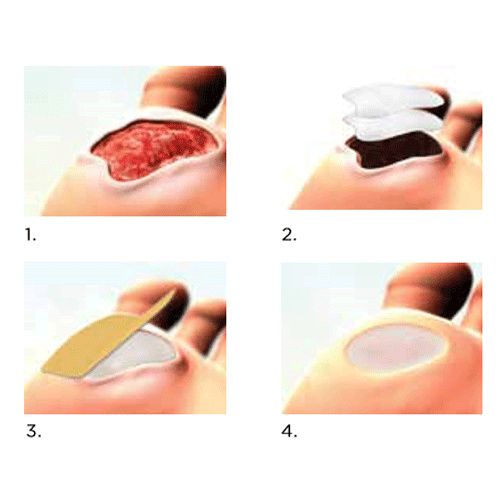 collagen dressings Collagen Dressing- Conkote