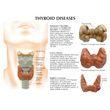 Anatomical Thyroid Disease Model - Labelled