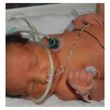 Neotech RAM Nasal Oxygen Cannula Usage